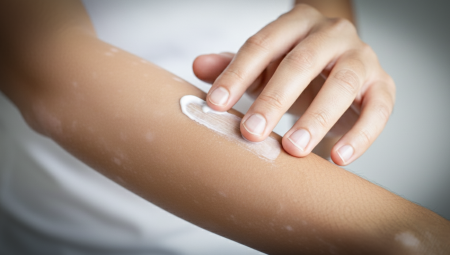 프로토픽·엘리델, 백반증 치료에도 건강보험 적용된다