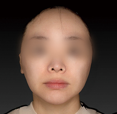 작은 얼굴 만들기 전후사진