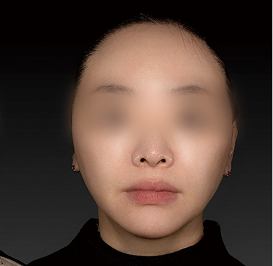 작은 얼굴 만들기 전후사진