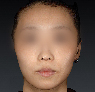 우아한 얼굴 만들기 전후사진