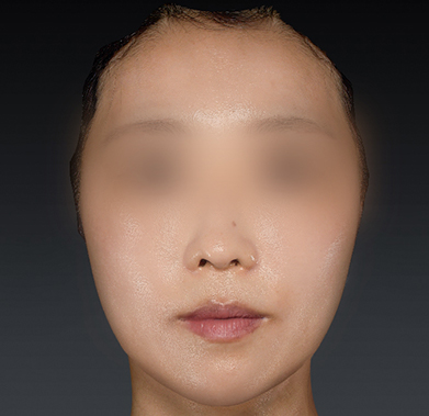 우아한 얼굴 만들기 전후사진