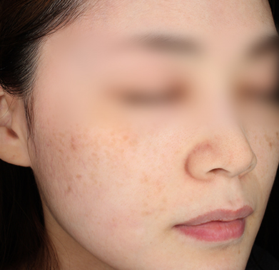 빛나는 얼굴 만들기 전후사진