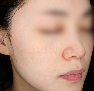 빛나는 얼굴 만들기 전후사진