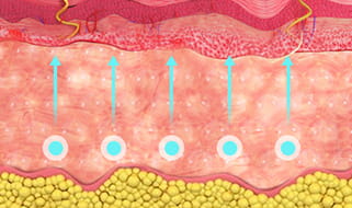 쥬베룩 진피층 주사