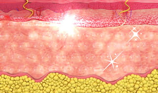 LDM 피부 진정 관리