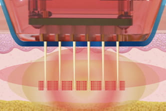 버츄RF 정밀 타겟 시술