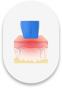 고주파 레이저 조사중