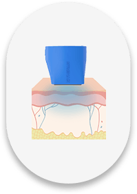 레이저 조사 후