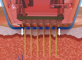 마이크로니들 접촉
