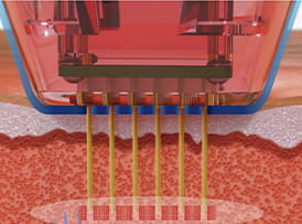 고주파 에너지 전달