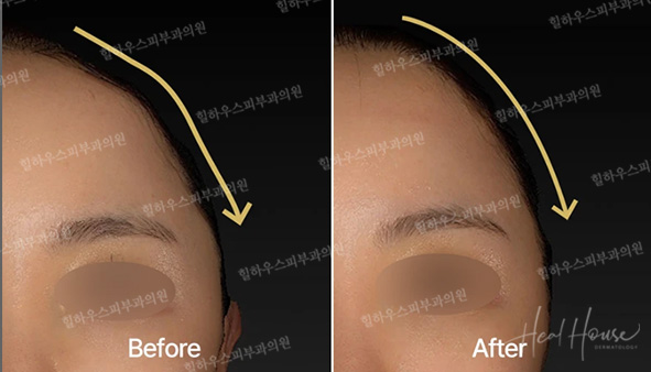 이마 라인과 얼굴 윤곽 변화를 보여주는 피부과 시술 전후 비교 이미지 이마 라인과 얼굴 윤곽 변화를 보여주는 피부과 시술 전후 비교 이미지