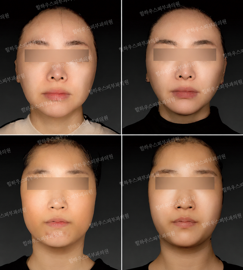 더엘주사 시술 전후 정면 비교 모음 — 발달했던 하관과 턱라인이 갸름하게 정돈된 사례 (개인차 있음)